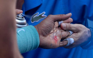 How to Prevent Blisters on Your Hands