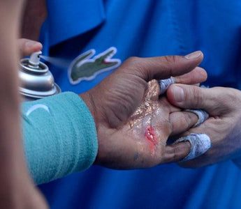 How to Prevent Blisters on Your Hands